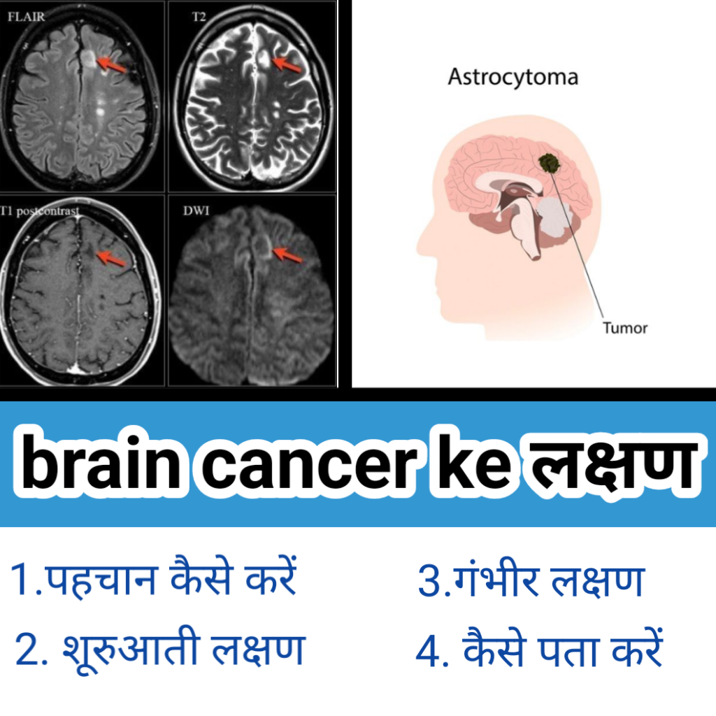 Brain Cancer Ke Lakshan