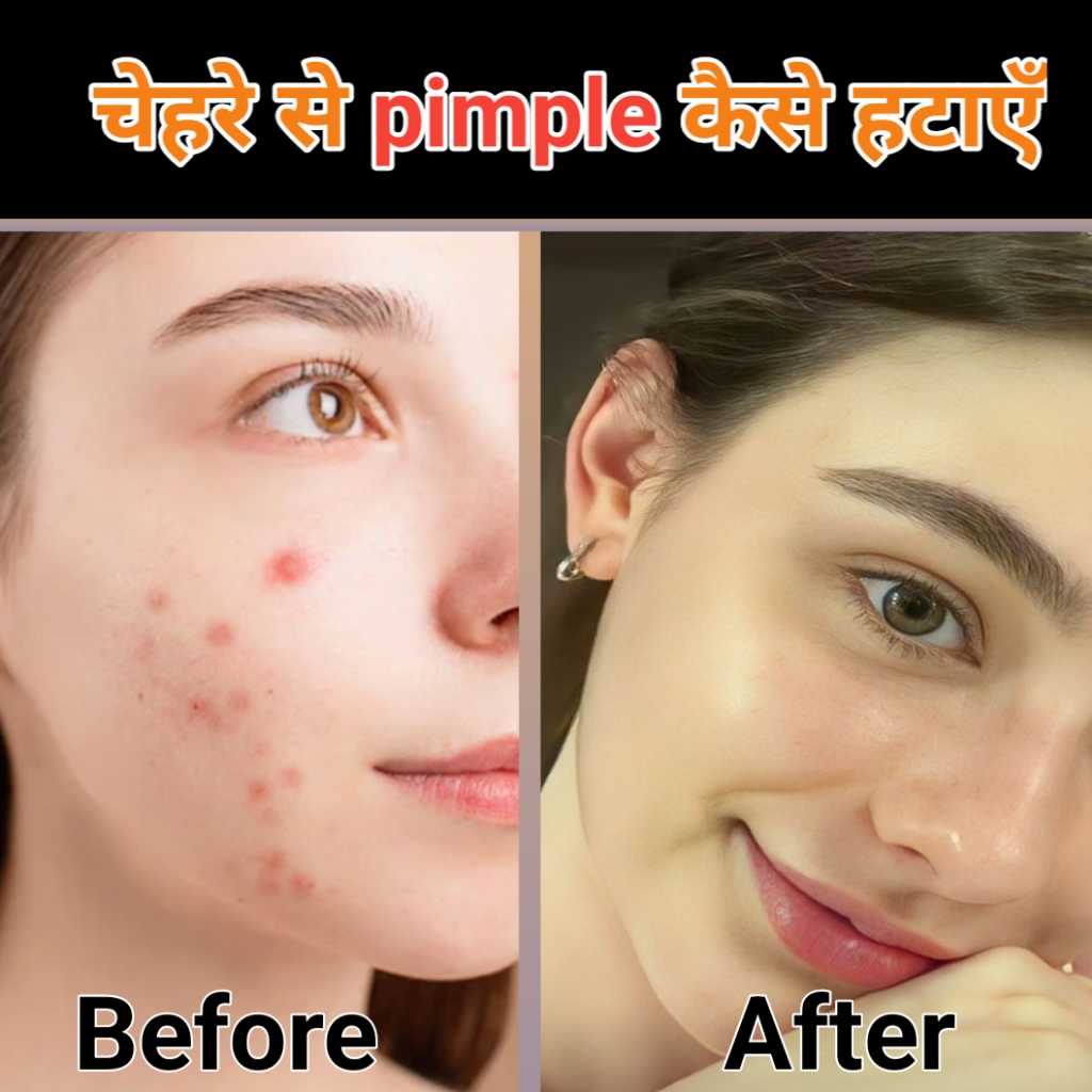 Chehre Se Pimple Kaise Hataye